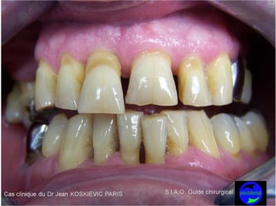 Guide chirurgical dentaire 01 lc936x - Eugenol