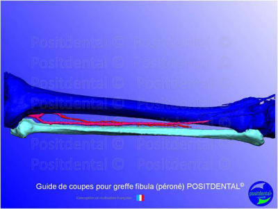 Guide de coupes pour greffe fibula  p ron   positdental 007 cwgnww - Eugenol