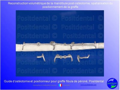 Guide de coupes pour greffe fibula  p ron    positdental 006 smxjnl - Eugenol