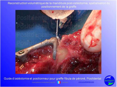 Guide de coupes pour greffe fibula  p ron    positdental 019 d8hz18 - Eugenol
