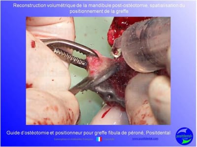 Guide de coupes pour greffe fibula  p ron    positdental 020 jxftsb - Eugenol