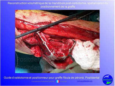 Guide de coupes pour greffe fibula  p ron    positdental 024 zz7nm2 - Eugenol