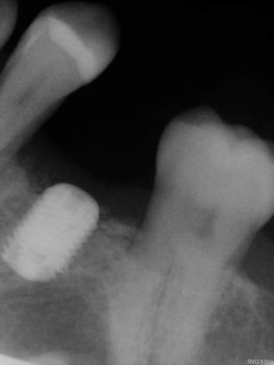 Implant15 n9xztf - Eugenol