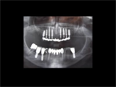 Implant dentsply ankylos et mci 11 gtz4mn - Eugenol