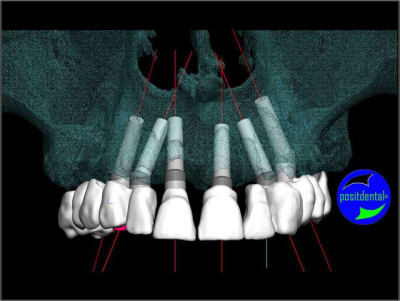Implant angul  positdental 4 cokooz - Eugenol