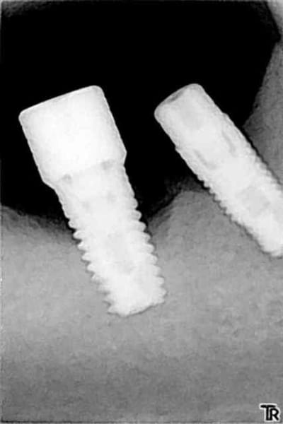 Implant apres vakapc - Eugenol