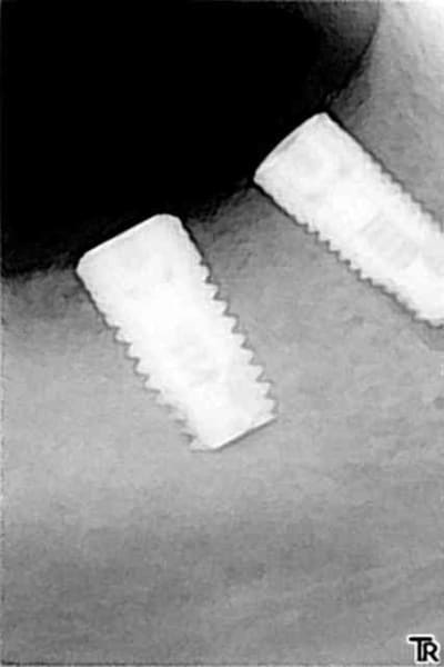 Implant avant mbll0u - Eugenol