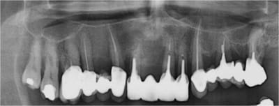 Implant et gestion des tissus conjonctif 02 i4iduv - Eugenol