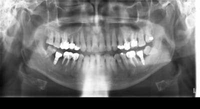 Implant qui casse z4wnbp - Eugenol