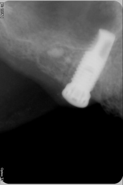 Implant szkoml - Eugenol