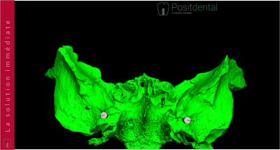 Implants ptérygoïdien 011 fvco9b - Eugenol