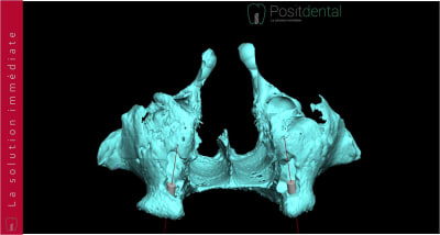 Implants ptérygoïdien 014 bwic2a - Eugenol