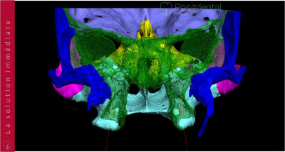 Implants ptérygoïdien 020 pcgmej - Eugenol