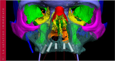 Implants ptérygoïdien 027 zfso0i - Eugenol