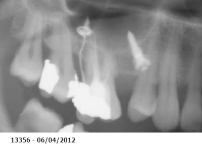 Ingression molaire2 mvlmwl - Eugenol