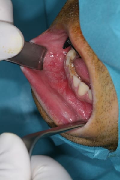 Kyste mand01 zudrso - Eugenol