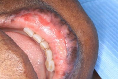 Lesions labiales 002  small  lcgas0 - Eugenol