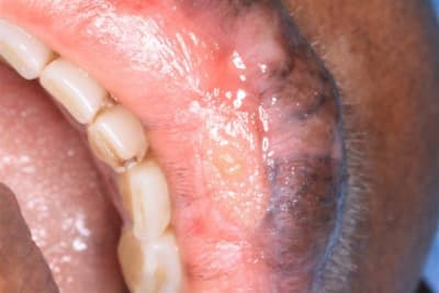 Lesions labiales 003  small  gaieck - Eugenol