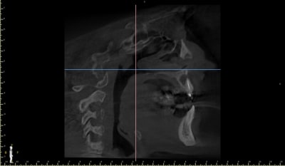 L sion 220 sagittal view rclrnl - Eugenol