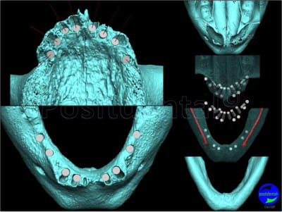 Mcipe bi maxillaire du 13 f vier 2012 006 h8qr9r - Eugenol