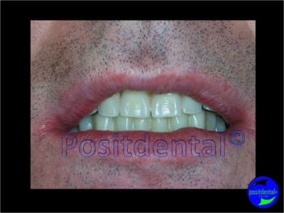 Mcipe bi maxillaire du 13 f vier 2012 008 sjst7t - Eugenol