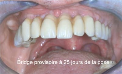 Mci   25 jours de la pose du bridge d0sgs5 - Eugenol