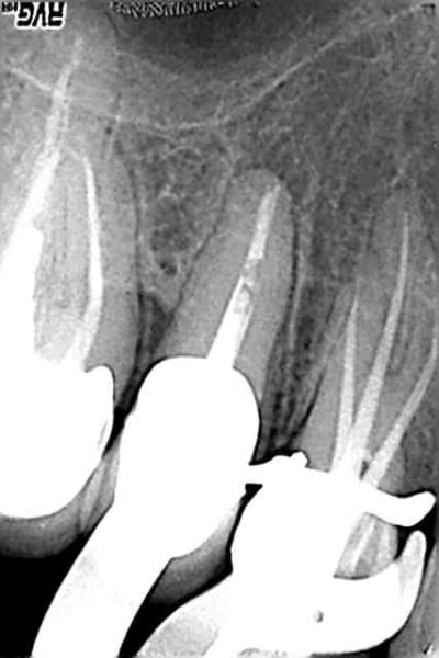 Mcz postop zqb1n1 - Eugenol