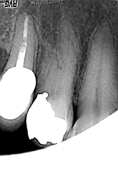 Mcz preop awelyv - Eugenol
