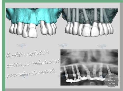 Mise en charge en 1 seul temps chirurgical 004 fts0os - Eugenol