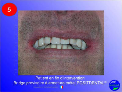 Mise en chage imm diate 185 lqrpsx - Eugenol