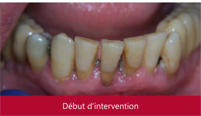 Mise en charge immédiate   protocole positdental 003 hpthml - Eugenol