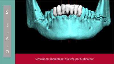 Mise en charge immédiate   protocole positdental 006 bx6dm7 - Eugenol