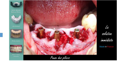 Mise en charge immédiate   protocole positdental 017 yydnfc - Eugenol