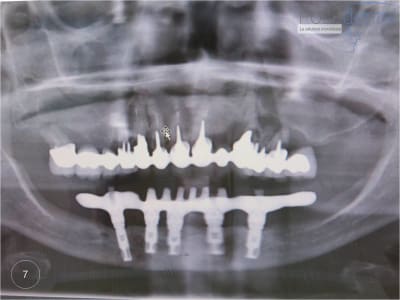 Mise en charge immédiate   chirurgie guidée 07 vhhqgo - Eugenol