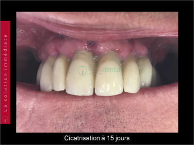 Mise en charge immédiate   chirurgie guidée guide chirurgical 004 c69uy6 - Eugenol