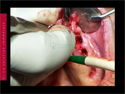 Mise en charge immédiate   chirurgie guidée guide chirurgical 016 nffkjf - Eugenol