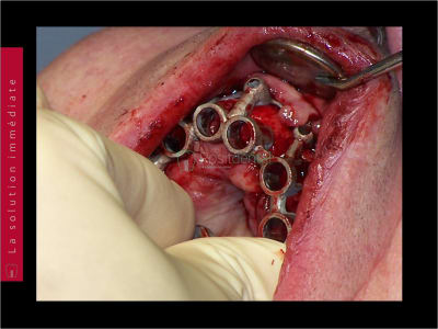 Mise en charge immédiate   chirurgie guidée guide chirurgical 021 simpzx - Eugenol