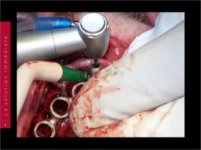 Mise en charge immédiate   chirurgie guidée guide chirurgical 022 lpfxjx - Eugenol