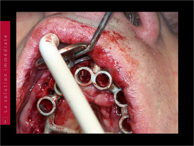 Mise en charge immédiate   chirurgie guidée guide chirurgical 027 ctyqyb - Eugenol