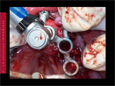 Mise en charge immédiate   chirurgie guidée guide chirurgical 038 jo9ns2 - Eugenol