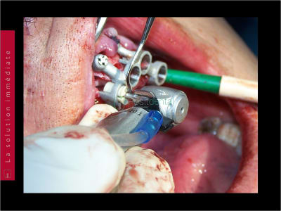 Mise en charge immédiate   chirurgie guidée guide chirurgical 042 ppnscs - Eugenol