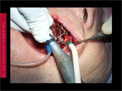 Mise en charge immédiate   chirurgie guidée guide chirurgical 047 kzv5qp - Eugenol