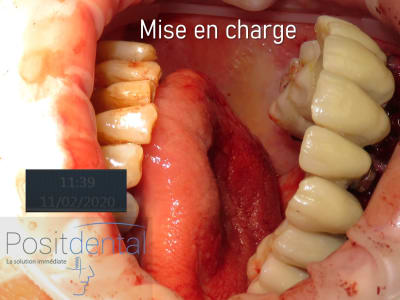 Mise en charge immédiate positdental002 auudjt - Eugenol