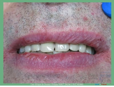 Mise en charge immédiate positdental r - Eugenol