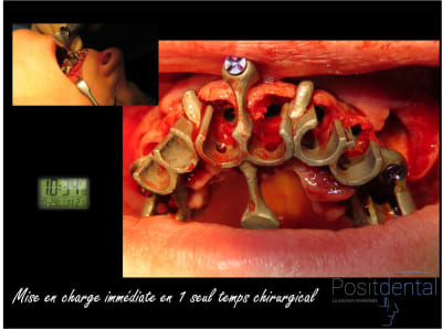 Mise en charge immédiate chirurgie guidée 009 gqnwce - Eugenol