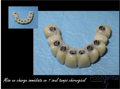 Mise en charge immédiate chirurgie guidée 014 a5wh53 - Eugenol