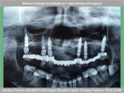 Mise en charge immédiate en 1 seul temps chirurgical protocole positdental 052 spmdyr - Eugenol