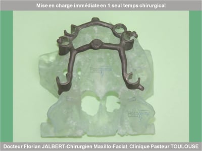 Mise en charge immédiate en 1 seul temps chirurgical protocole positdental 053 cg0ndc - Eugenol