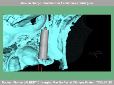 Mise en charge immédiate en 1 seul temps chirurgical protocole positdental 058 lnlmk4 - Eugenol