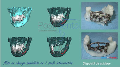 Mise en charge immédiate en 1 seule intervention la solution immédiate positdental 002 yfqi1h - Eugenol